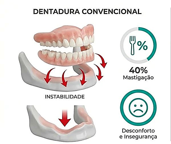 Dentadura convencional causa instabilidade e perda óssea