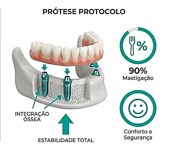 Prótese protocolo sobre implantes oferece estabilidade total