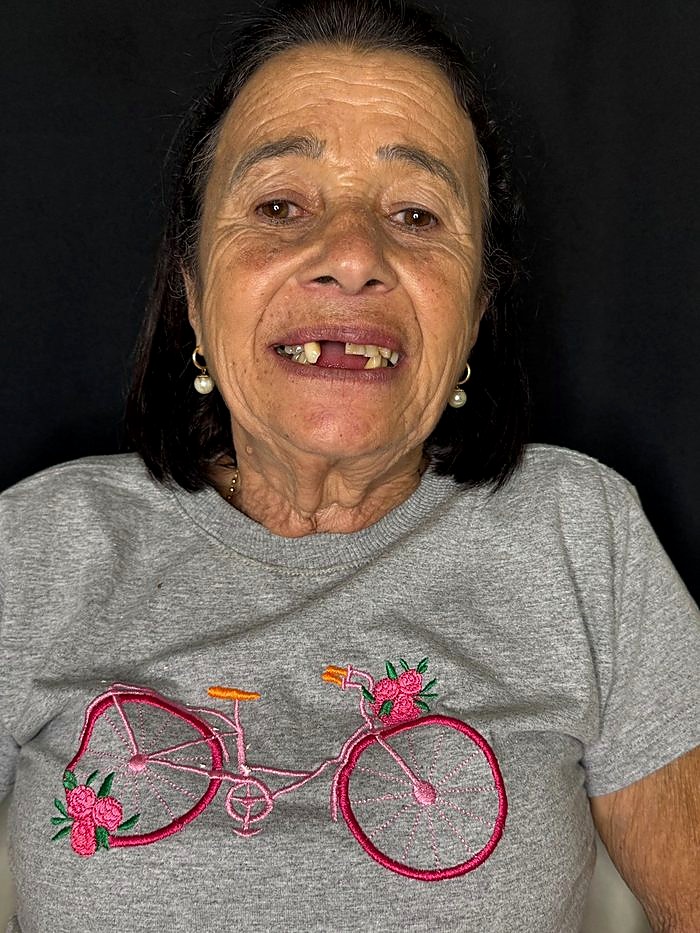 Sorriso antes do tratamento de implante
