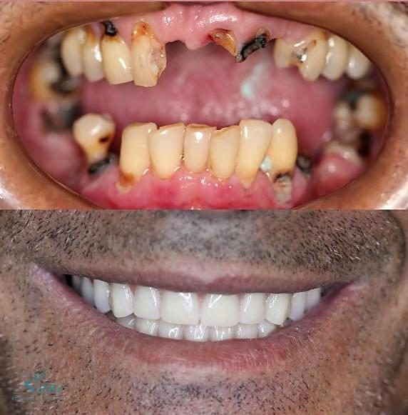 Transformação de sorriso com implante dentário