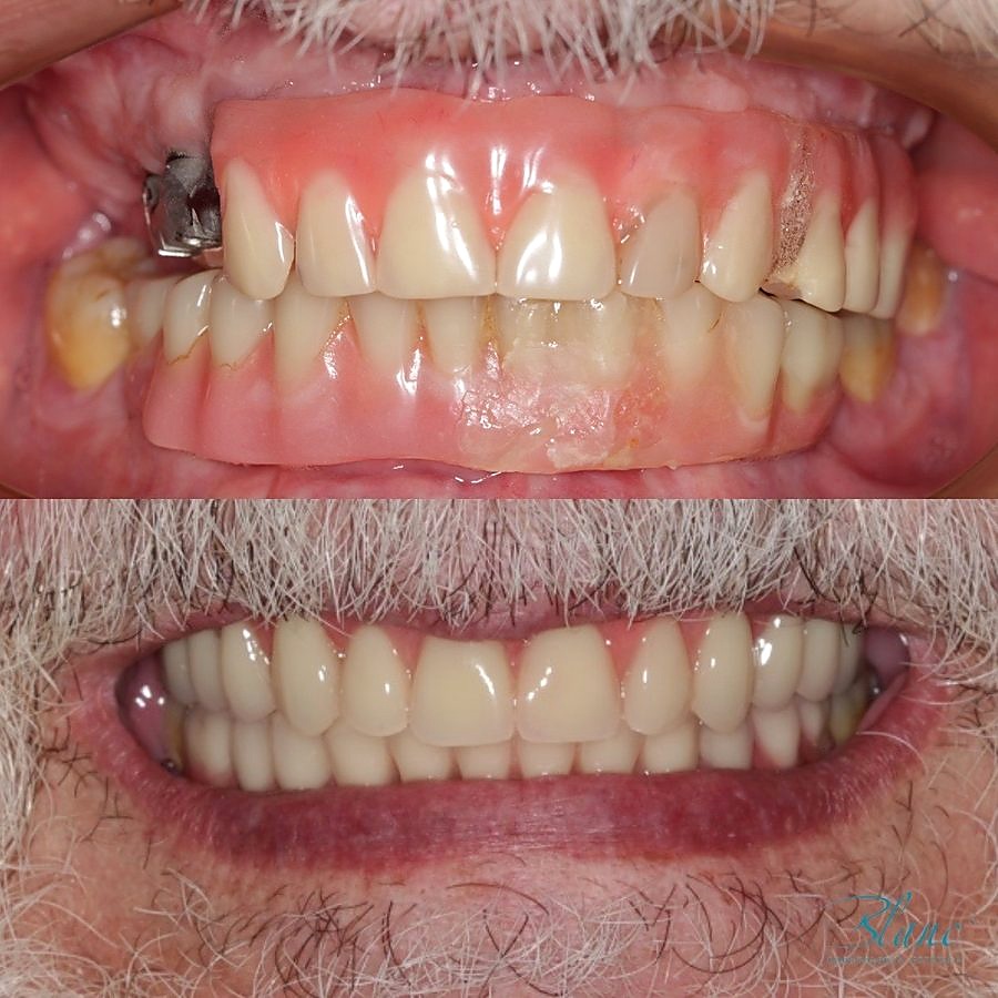 Transformação de sorriso com implante dentário