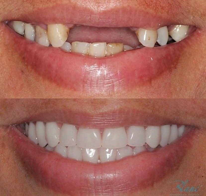 Transformação de sorriso com implante dentário